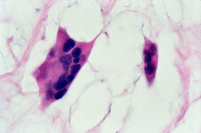 Figura 10. - Clula mixoma multinucleada. Hematoxilina & eosina, 100x.